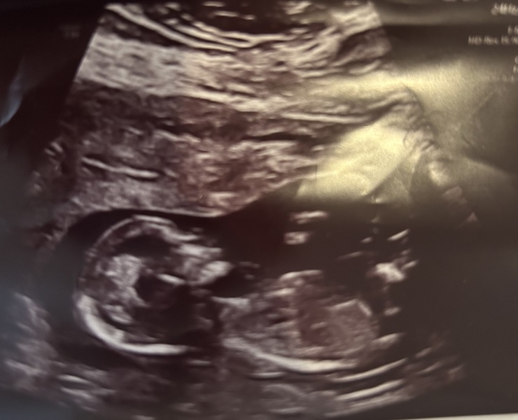 First cycle - IVF / ICSI - Day 4 
