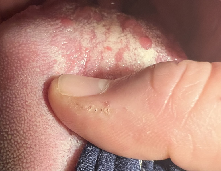 Tongue blisters?