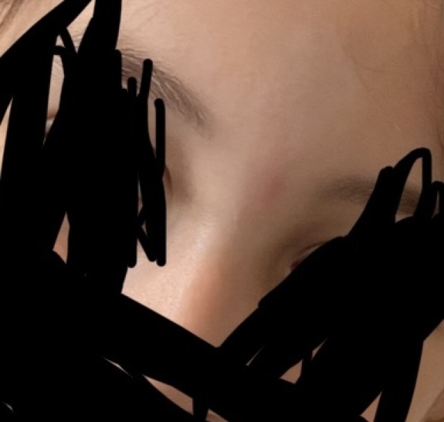 Help! Scar on my LO's face