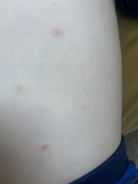 Does this look like chickenpox? 