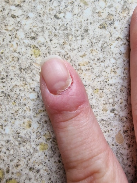 I am going to lose my nail?