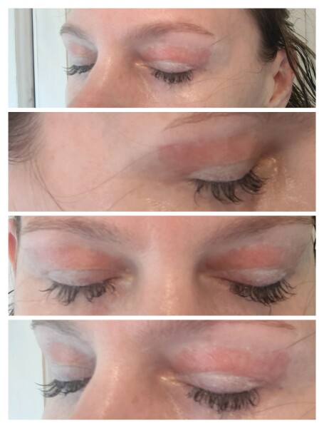 Has anyone been left with scarring after plasma pen/fibroblast?