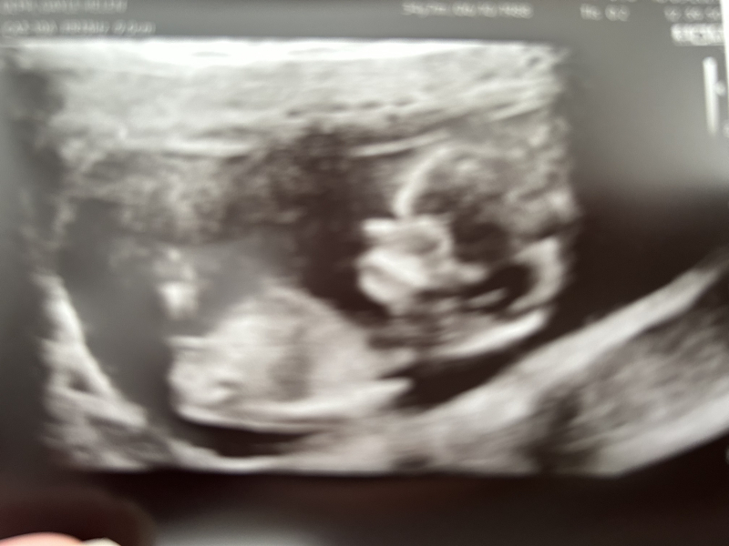 Ivf pregnancy - first trimester