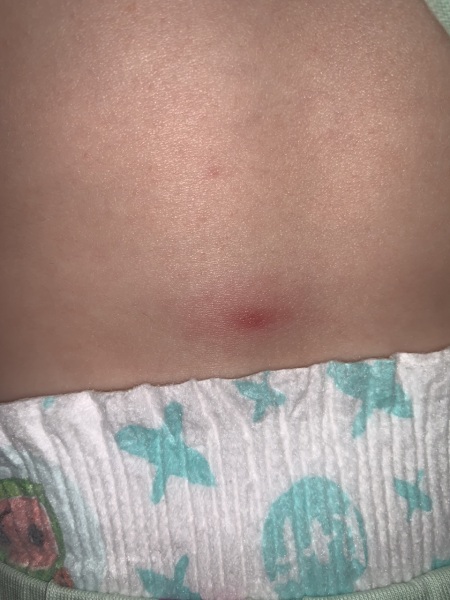 22mo has painful spot/lump on her back
