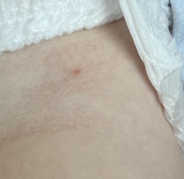 Is this Chickenpox? 