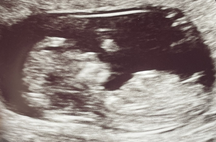 Nub/Skull Theory! Girl or Boy? 