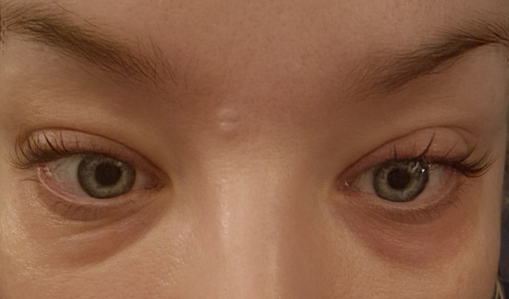 Has anyone been left with scarring after plasma pen/fibroblast?