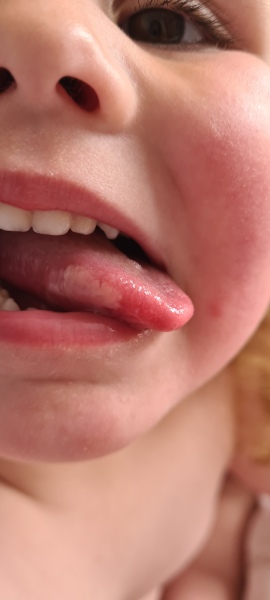 White tongue & red rash