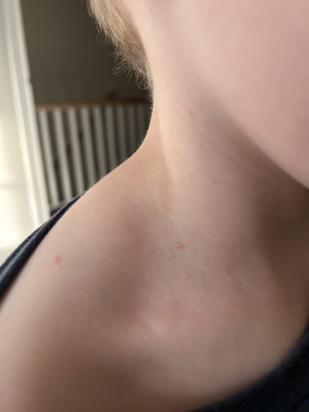 Chicken pox?