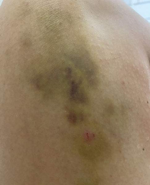 To wonder what on earth chomped my leg? 