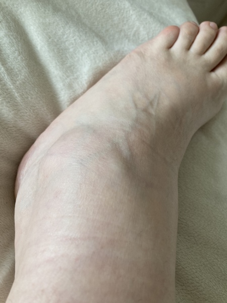 Swollen ankle and foot after walking- photo attached 