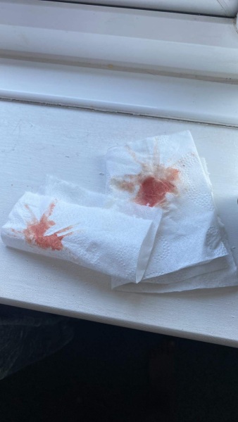 implatation bleeding!