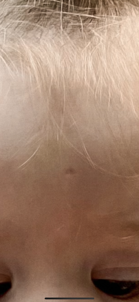 Toddler forehead scar