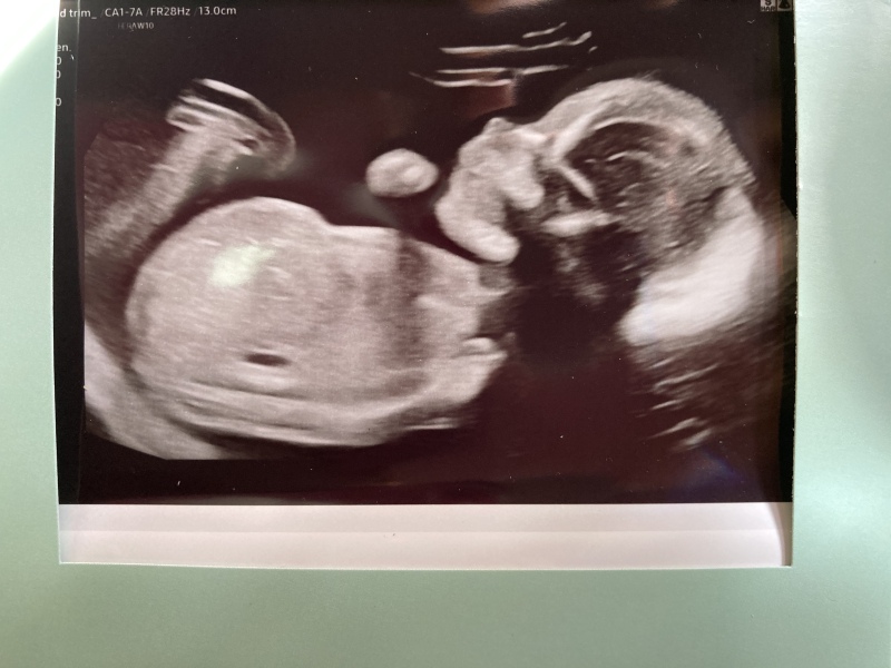 20 week scan - am I mad or am I seeing a uterus??