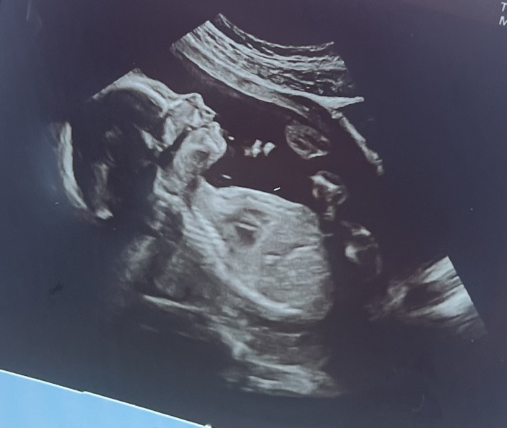 First cycle - IVF / ICSI - Day 4 