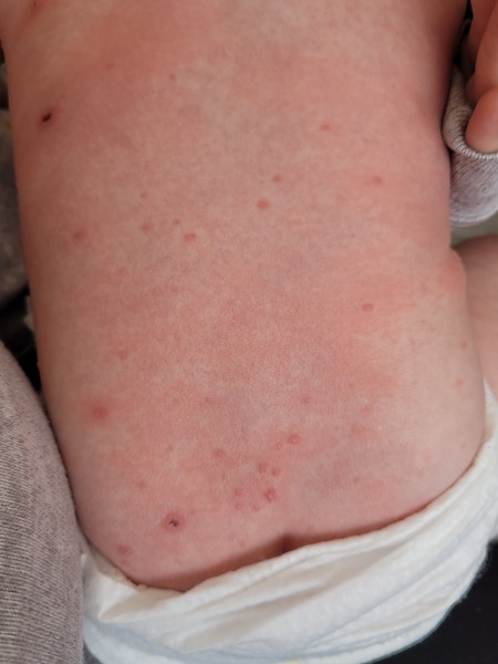 Chickenpox