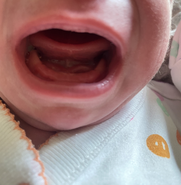 Tongue tie?