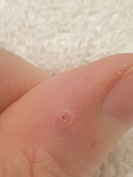 Is this what happens to warts?