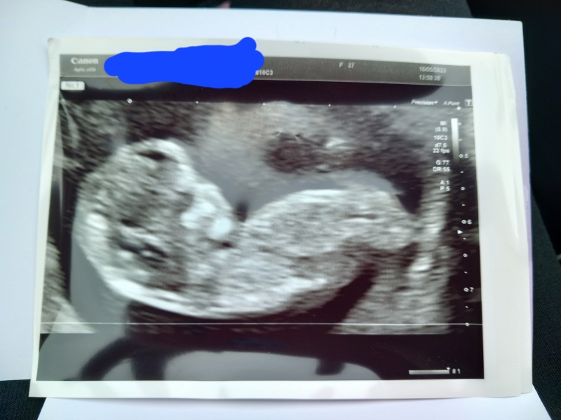 What is this on ultrasound?