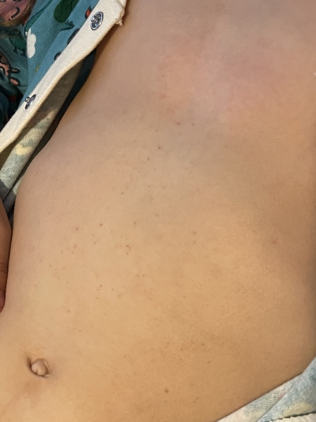 Rash? 