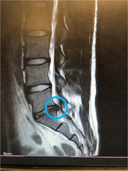 18-year-old DS's excruciating, years-long sciatica – need hope