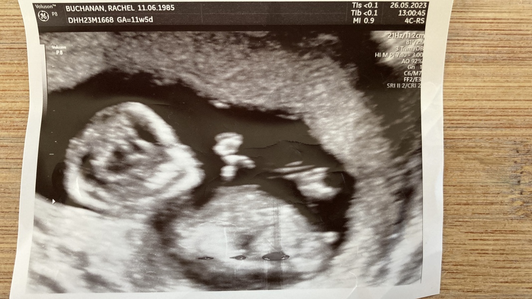 Boy or Girl what do we think?