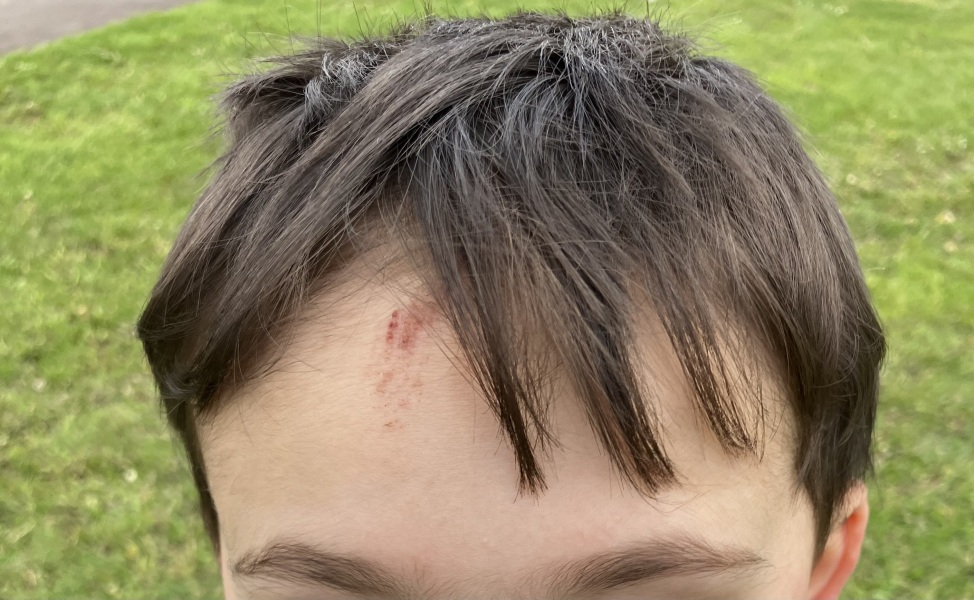 Dd fell over, slight graze on head but nursery didn’t tell me..