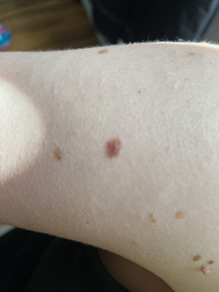 Dodgy mole