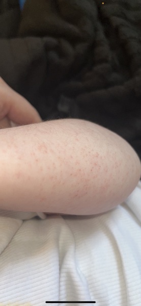 What is this rash??