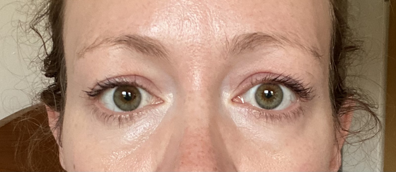 Is there a magic cream to tighten eye bags?!