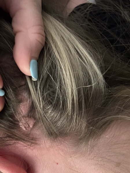 Funny looking mole on head (TW: picture)