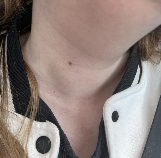 Purple dot on neck on asprin and blood thinners 