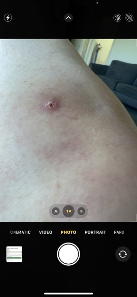 Ingrown hair won't die!!