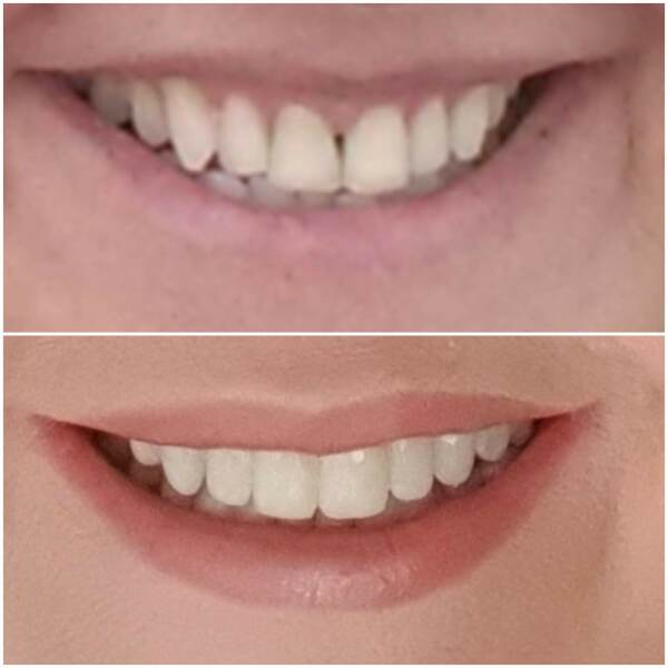 Teeth whitening and straightening potentially