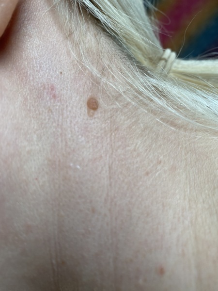 New mole