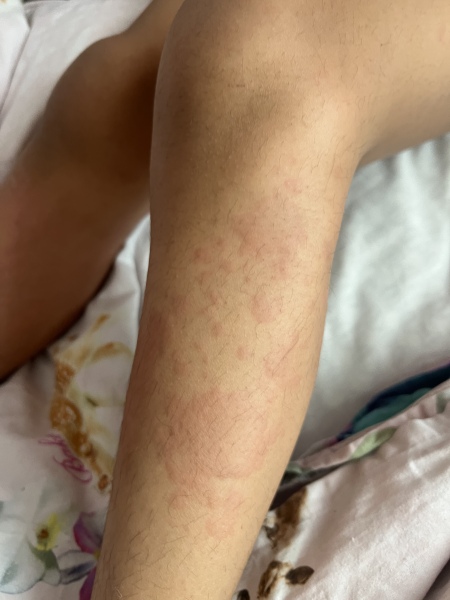 Can some one help me around this rash 