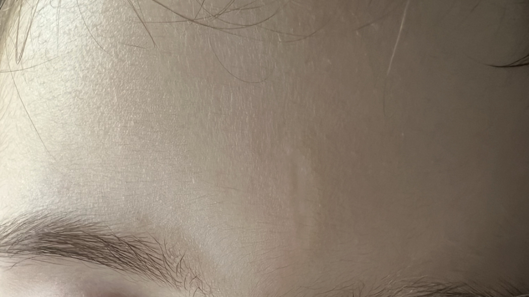 Help! Scar on my LO's face