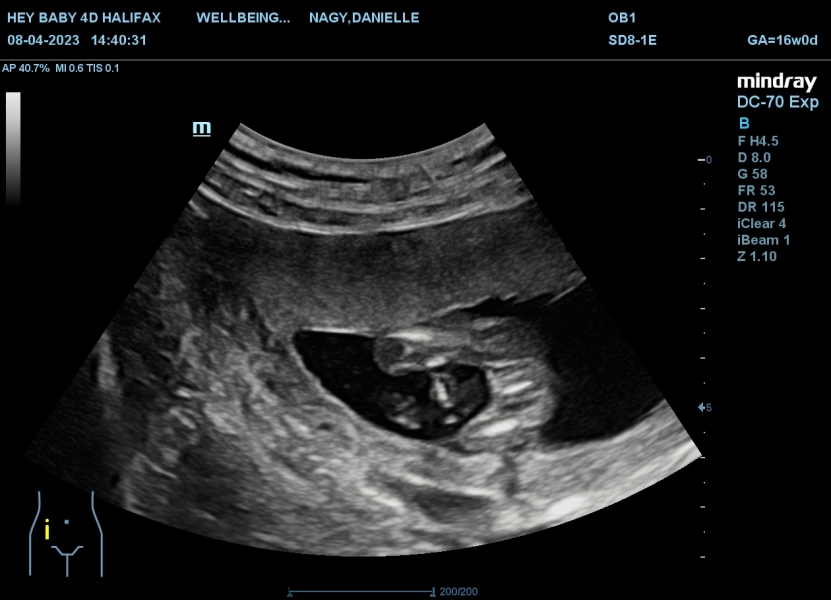 Anyone worried their private gender scan is wrong?