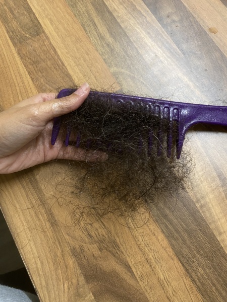Postpartum hair loss