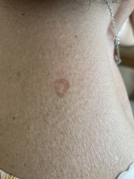 Is this an age spot ? 