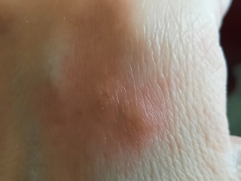 What has bitten me?  Photos