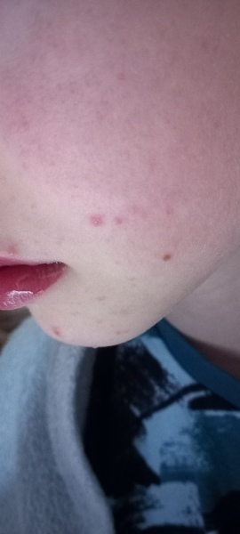 Is this chickenpox?