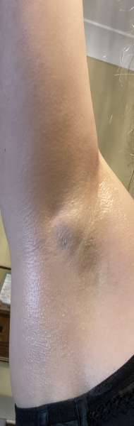 Armpit lump