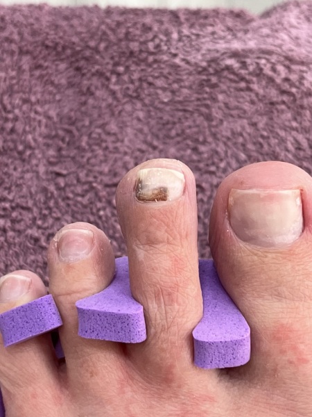Is this a fungal nail infection? Sorry for horrible pic!