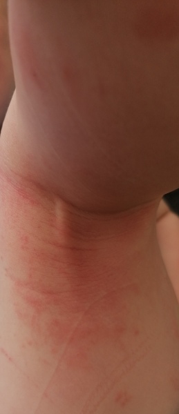 Private dermatologist for DC reccomendations. Pics attached 