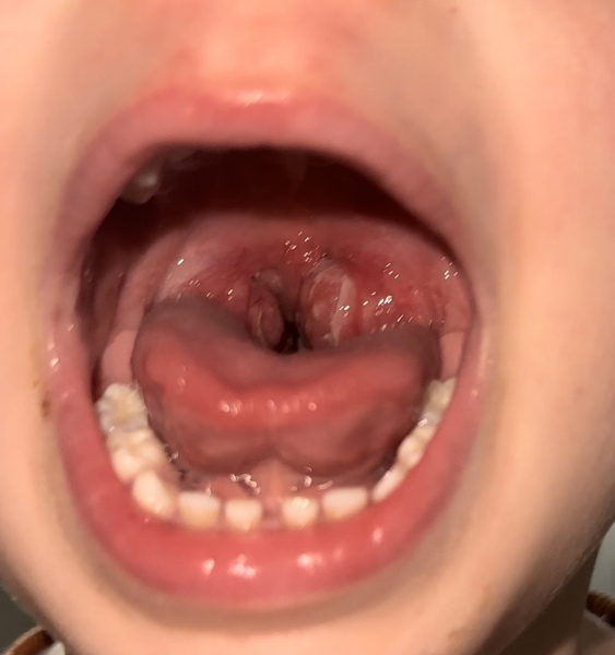 White tonsils with a cold?