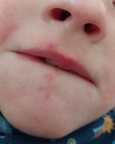 Sores?