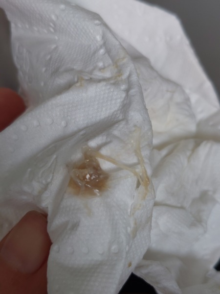 Difficult transfer and a clot the day after
