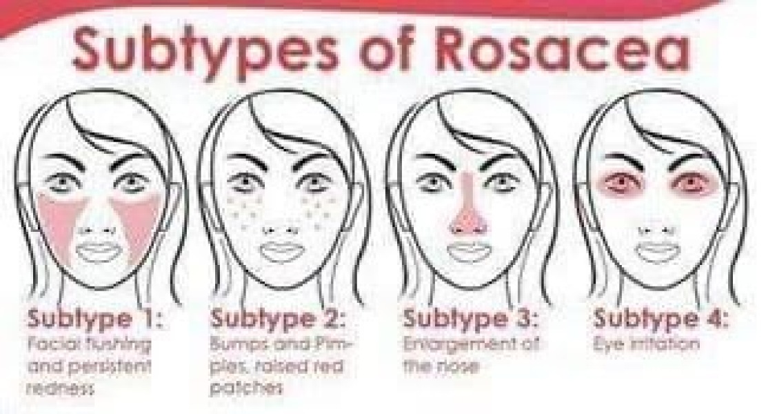 Rosacea! Anyone found an effective treatment.