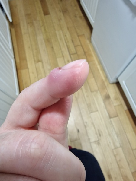 I am going to lose my nail?